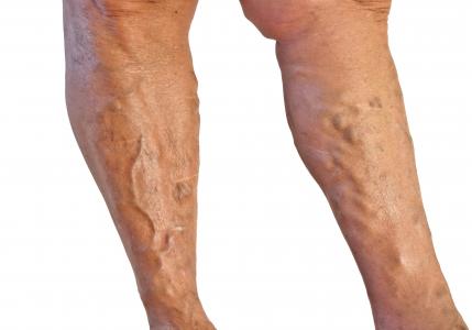 Причины появления жжения в ногах и методы лечения